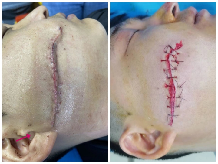 点阵激光后的伤口要几天愈合,伤口做点阵激光治疗