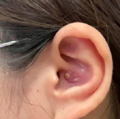 外耳道疖还没长出来但是已经疼了,外耳道疖的主要症状有哪些