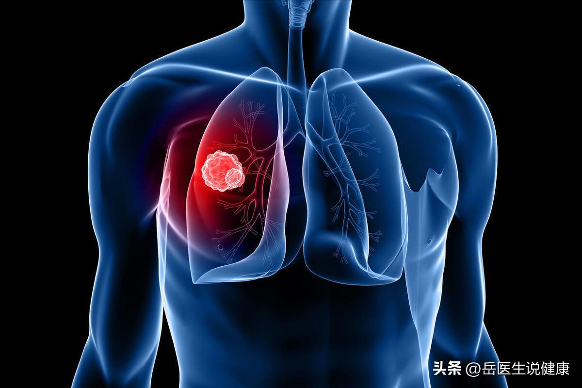 肺癌引起肩疼和一般肩疼区别,肩痛可能是肺癌早期