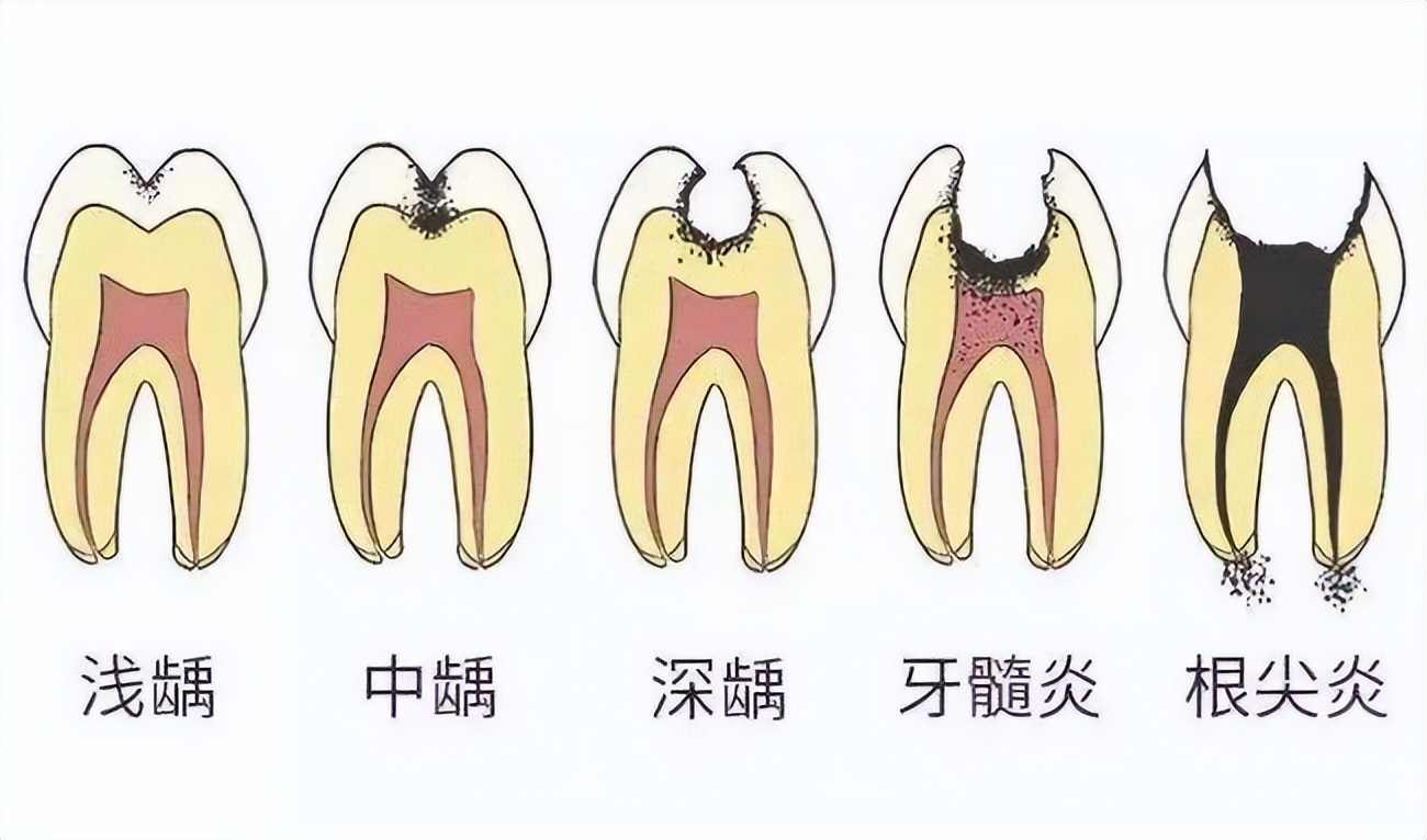 门牙邻面龋坏修复视频,龋齿修补后又龋坏了怎么办