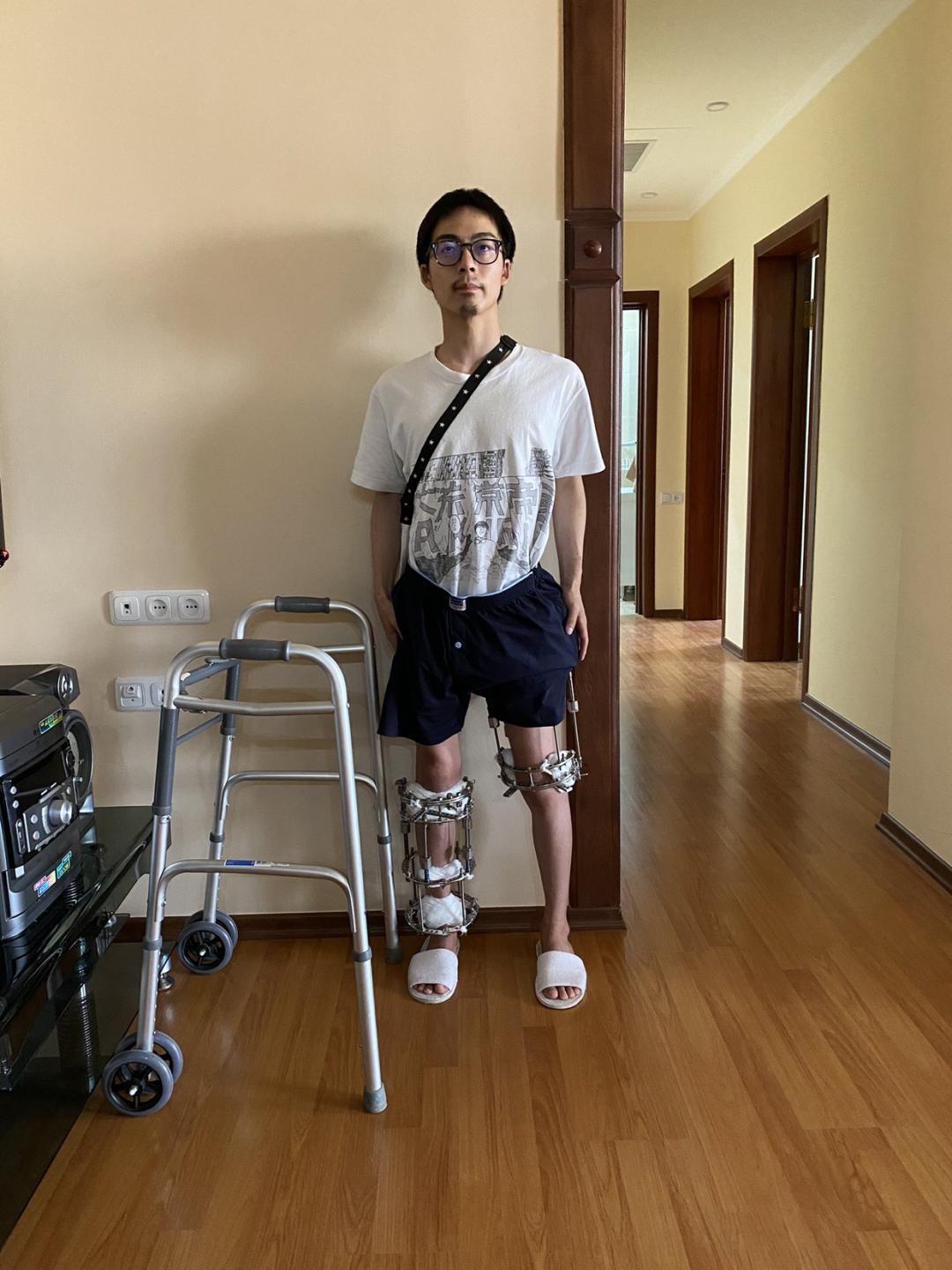 日本1米5小哥砸1600万疯狂整容增高！断骨惨烈过程吓傻网友