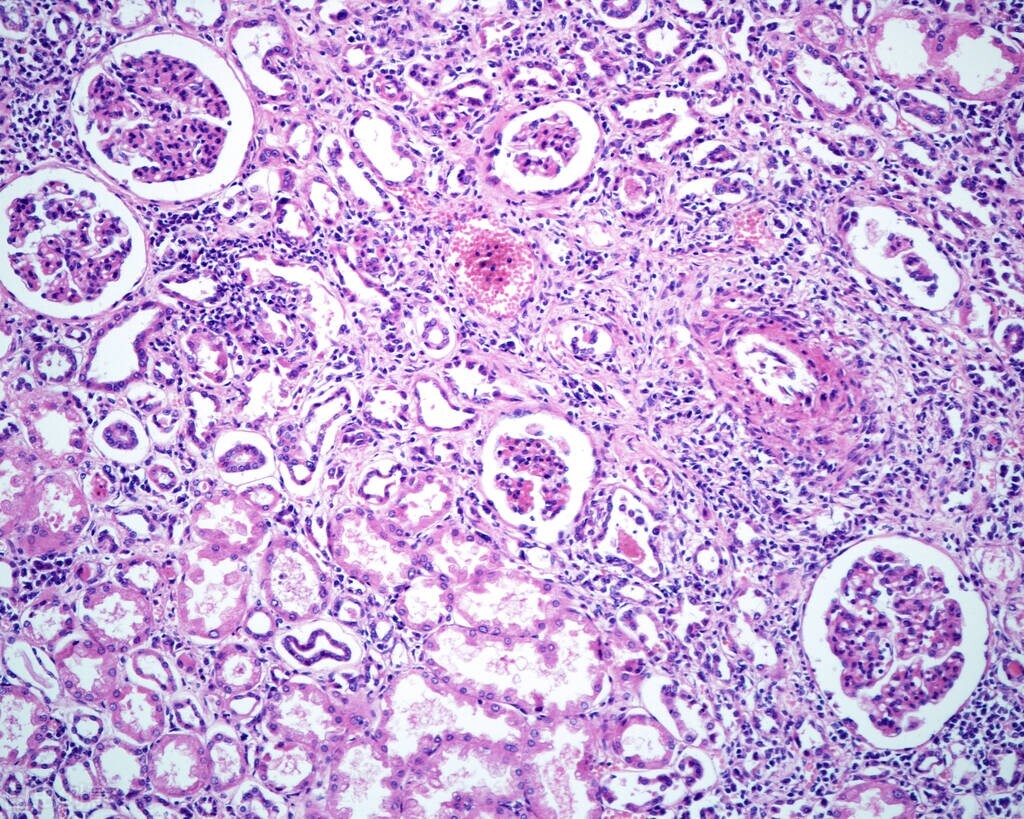 荨麻疹血管炎的检查方法,系统性血管炎要检查什么