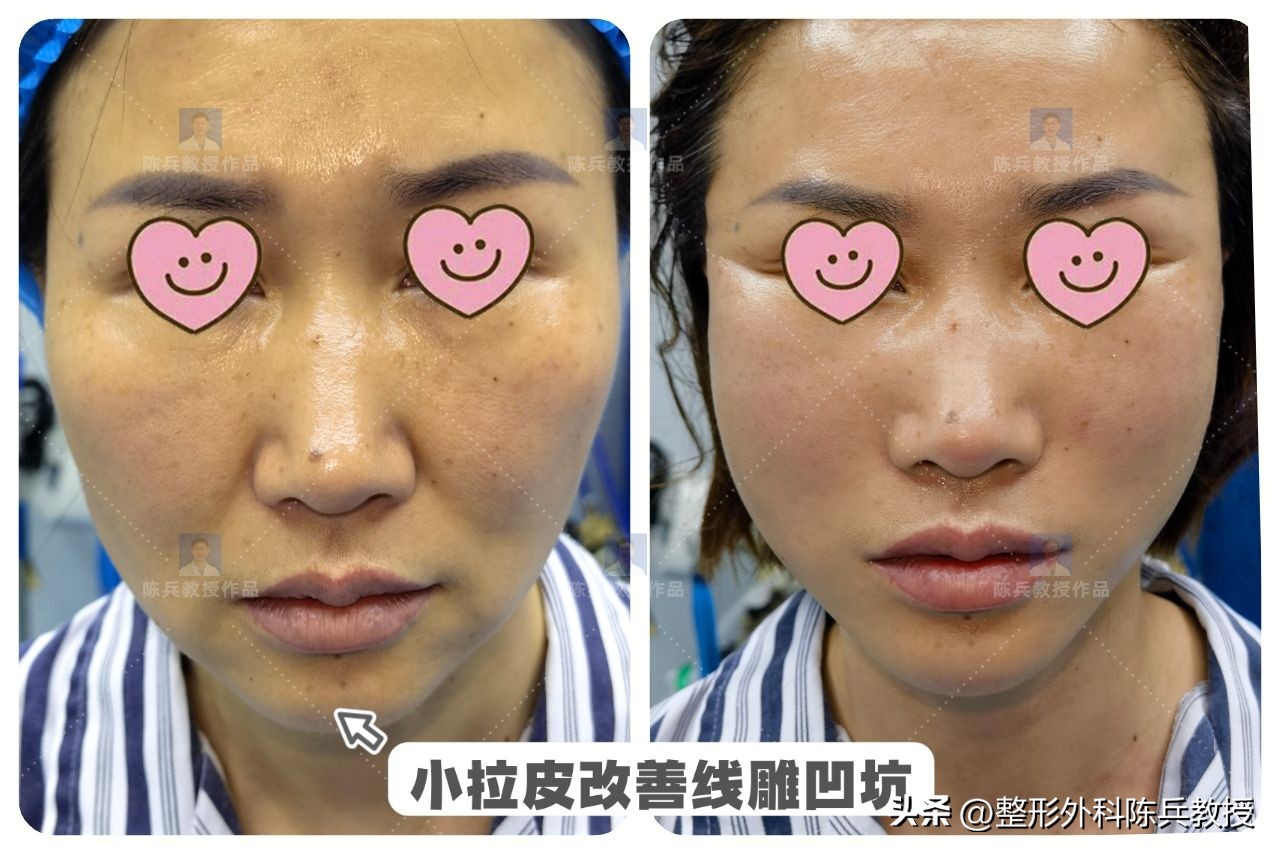 面部皮肤紧致可以做小拉皮吗,面部小拉皮效果怎么样