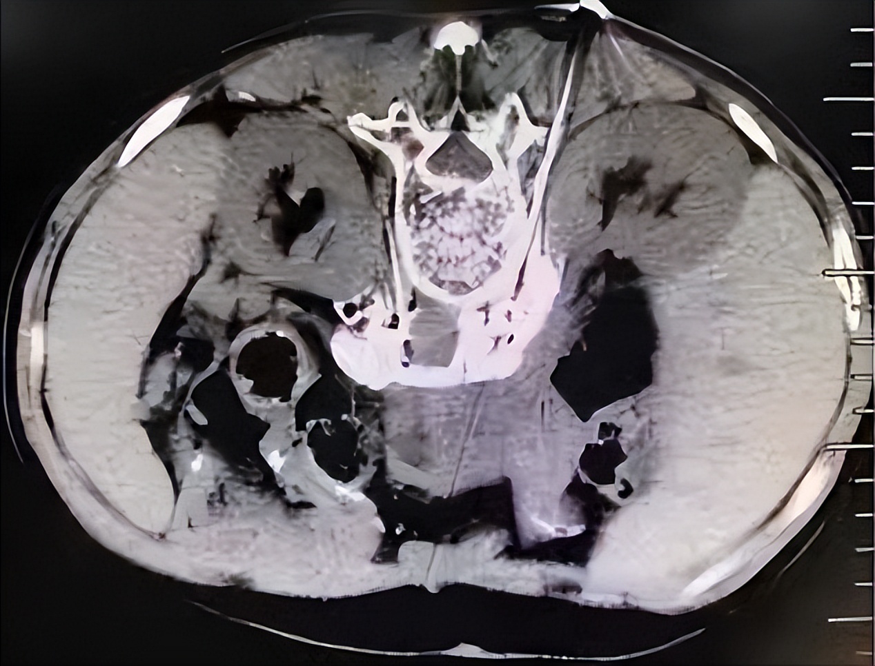 【病例档案馆】介入快报（第2期）