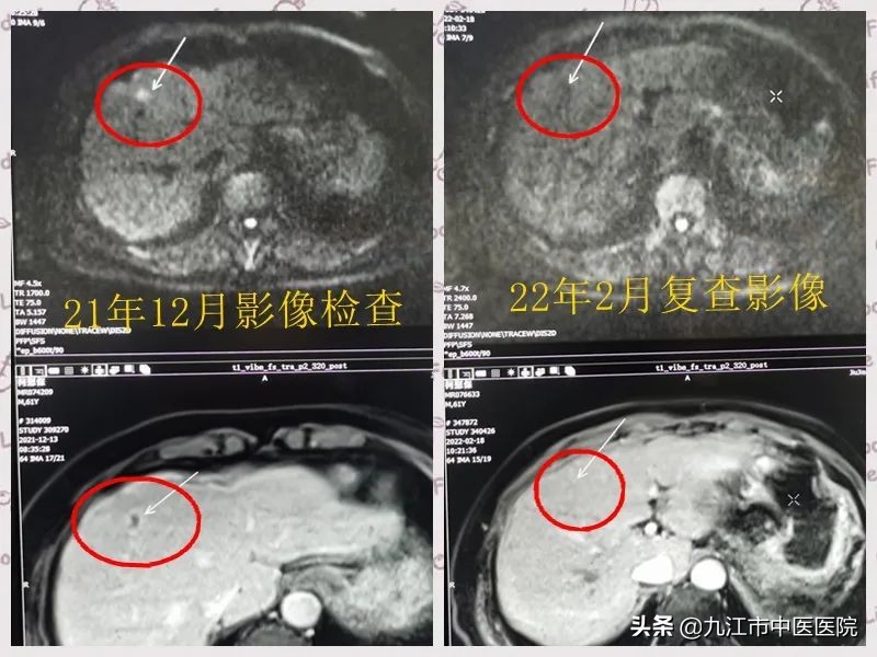 【杏林春暖】肝内转移病灶消失，九江市中医医院成功运用中医药治疗癌症患者