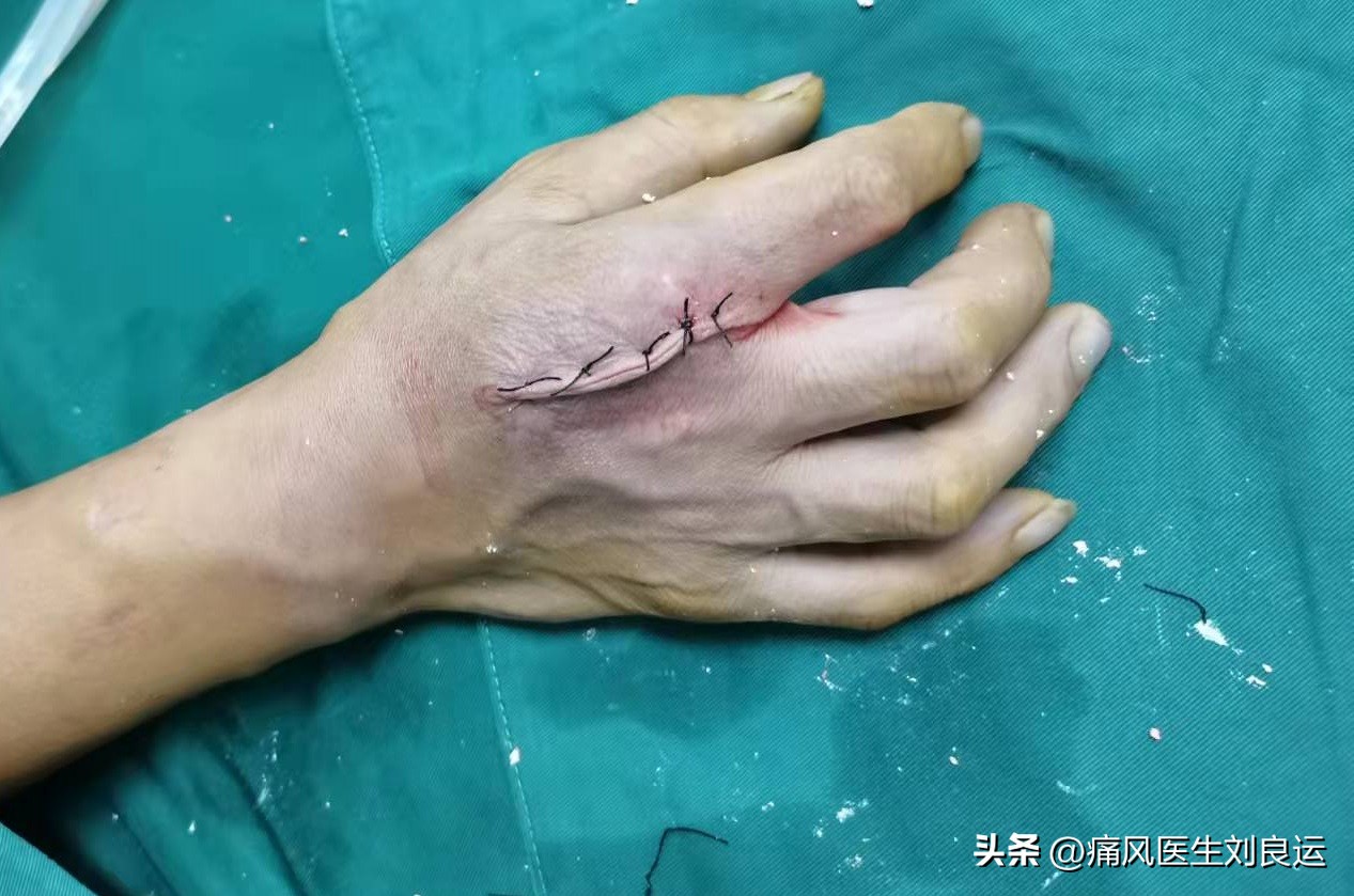 服用降尿酸药痛风发作要不要停药,治疗痛风不可操之过急