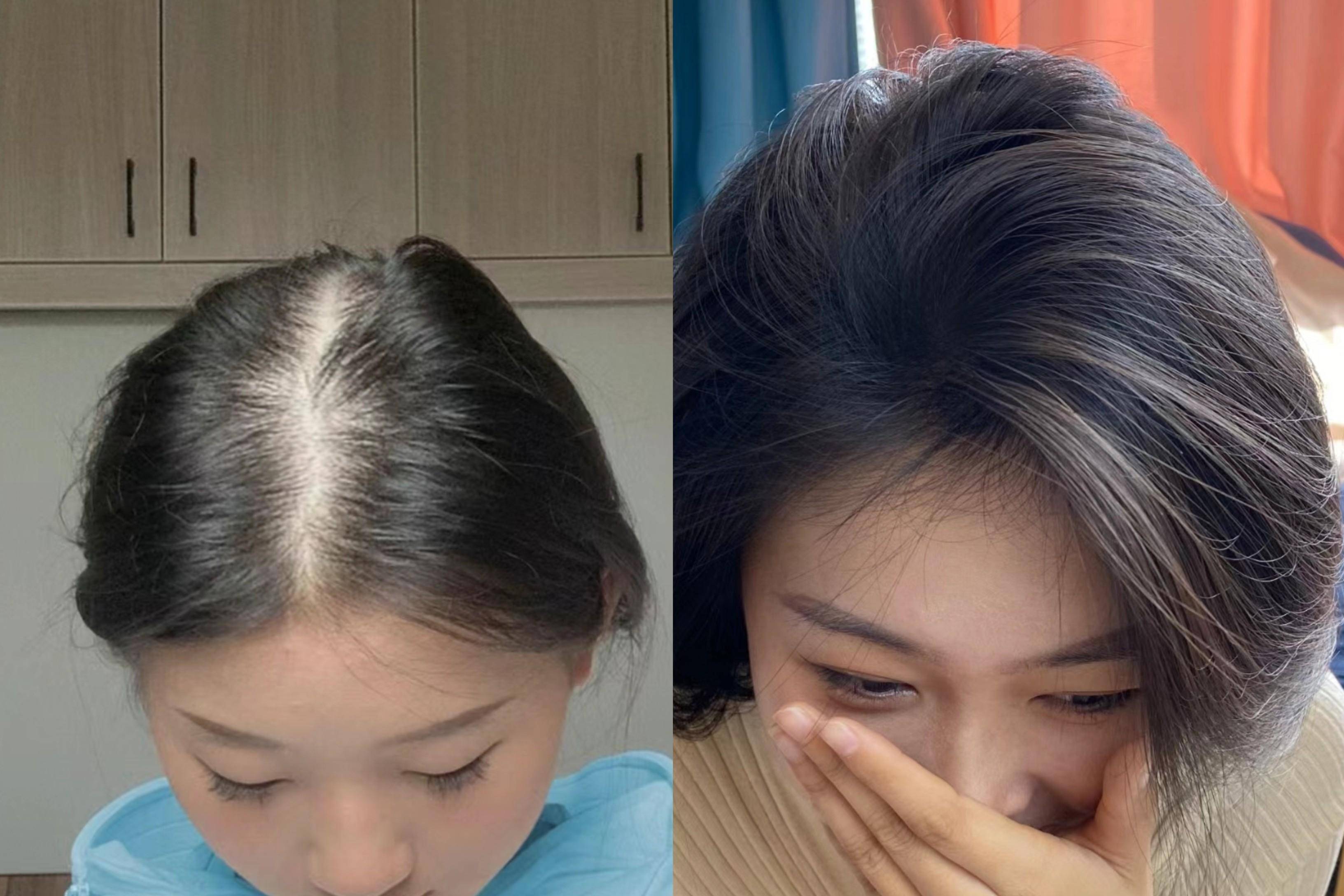 头发超细且掉发怎么改善,改善头发干枯毛躁分叉掉发