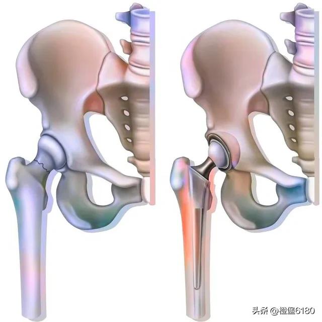 股骨转子间骨折pfna手术记录,股骨骨折mri