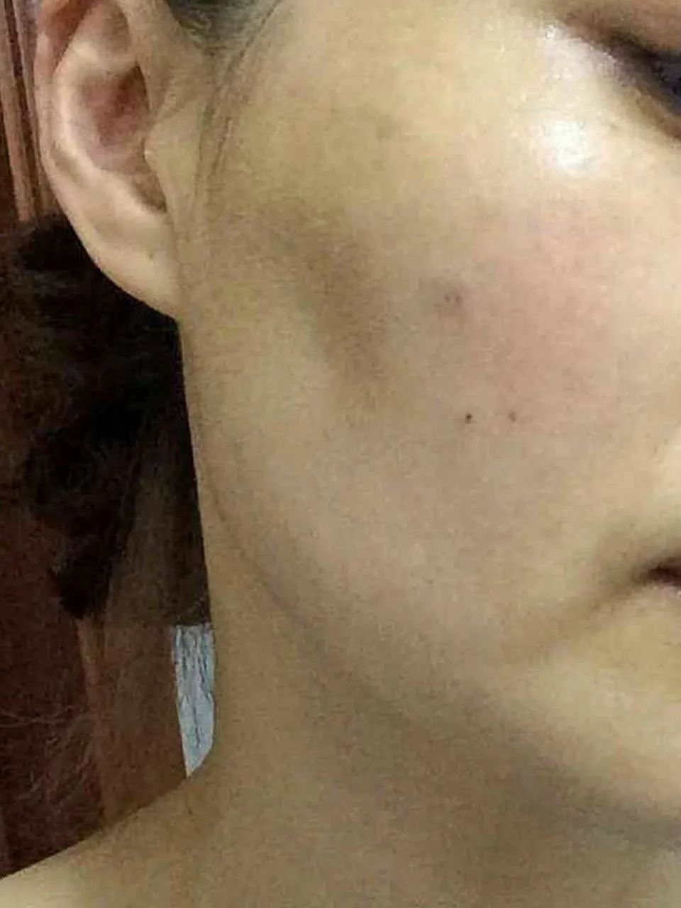 肉毒素打到腮腺,肉毒素可以打腮腺么