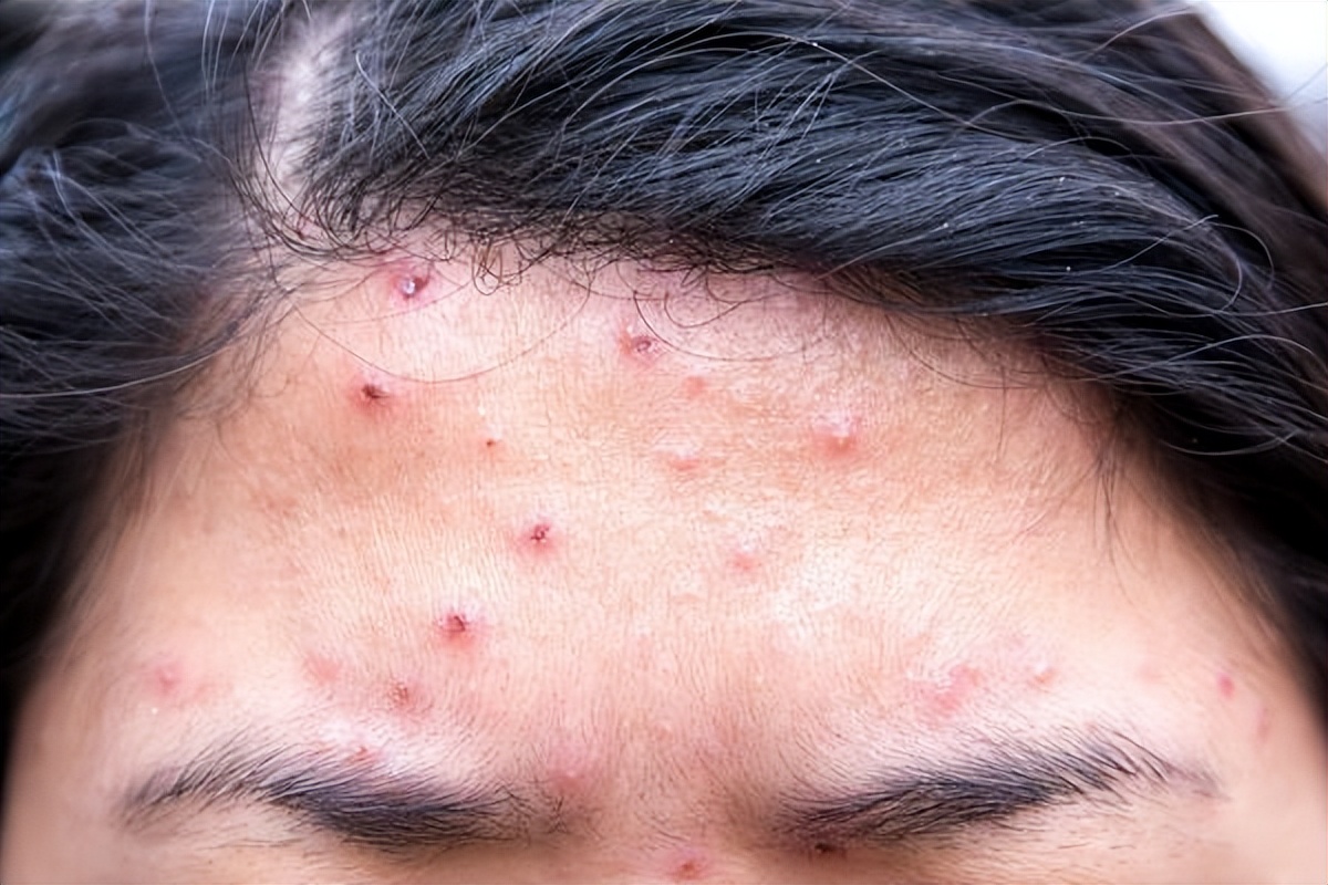 头上长痘一抠就有头皮屑,头上长了颗痘痘结痂掉皮