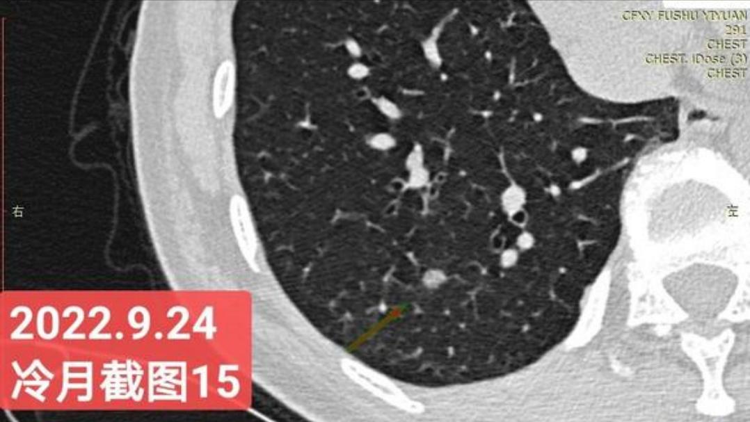 7mm肺结节恶性的怎么办,7mm实性肺结节危险程度