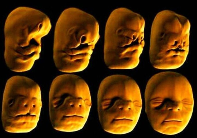 宝宝是一只“小兔子”，还没长牙就要开始正畸了