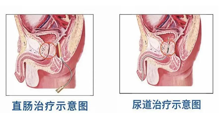 博尔肽治疗前列腺,博尔肽前列腺治疗仪