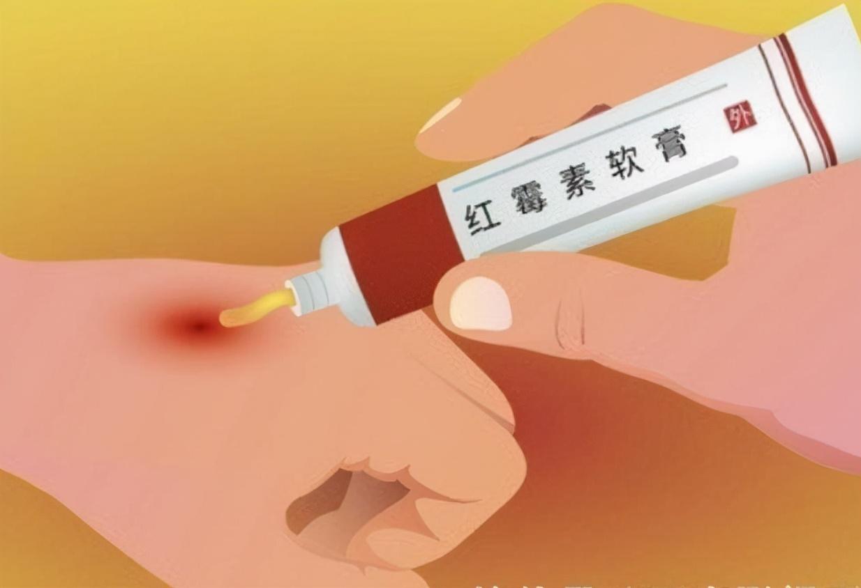 红霉素软膏能治老年斑吗,老人皮肤痒可以用红霉素软膏吗