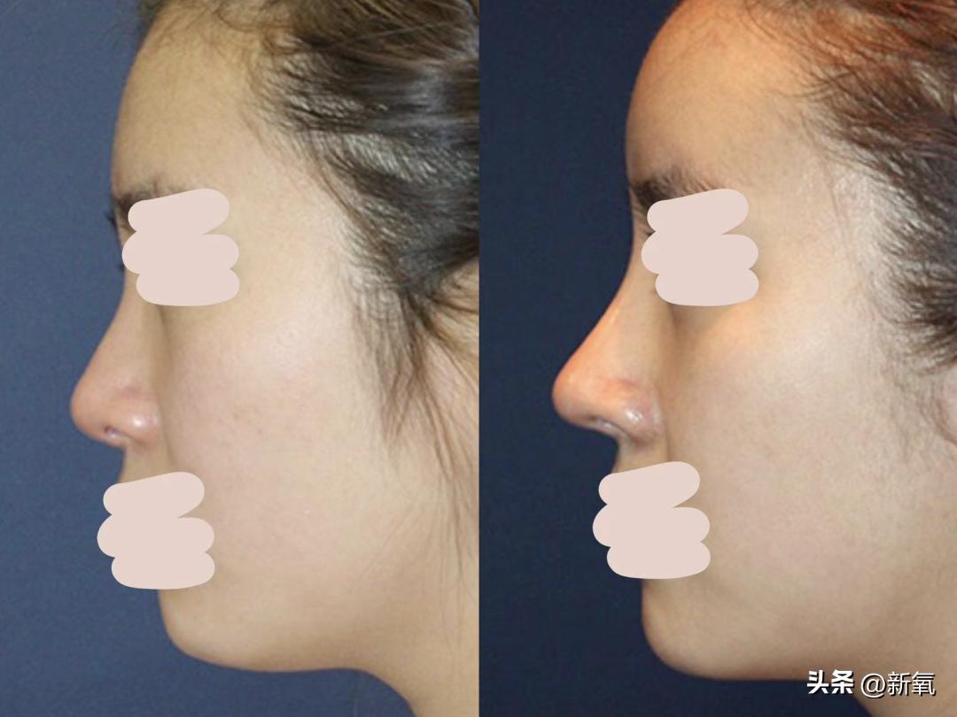 改一点赢很大？她整完鼻子直接美成断代神颜…