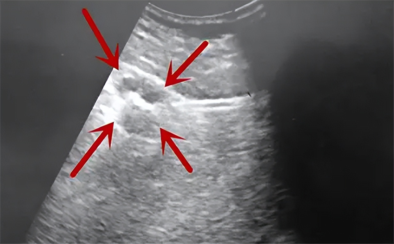 24岁女生确诊肝癌晚期崩溃,29岁护士突发疾病逝世