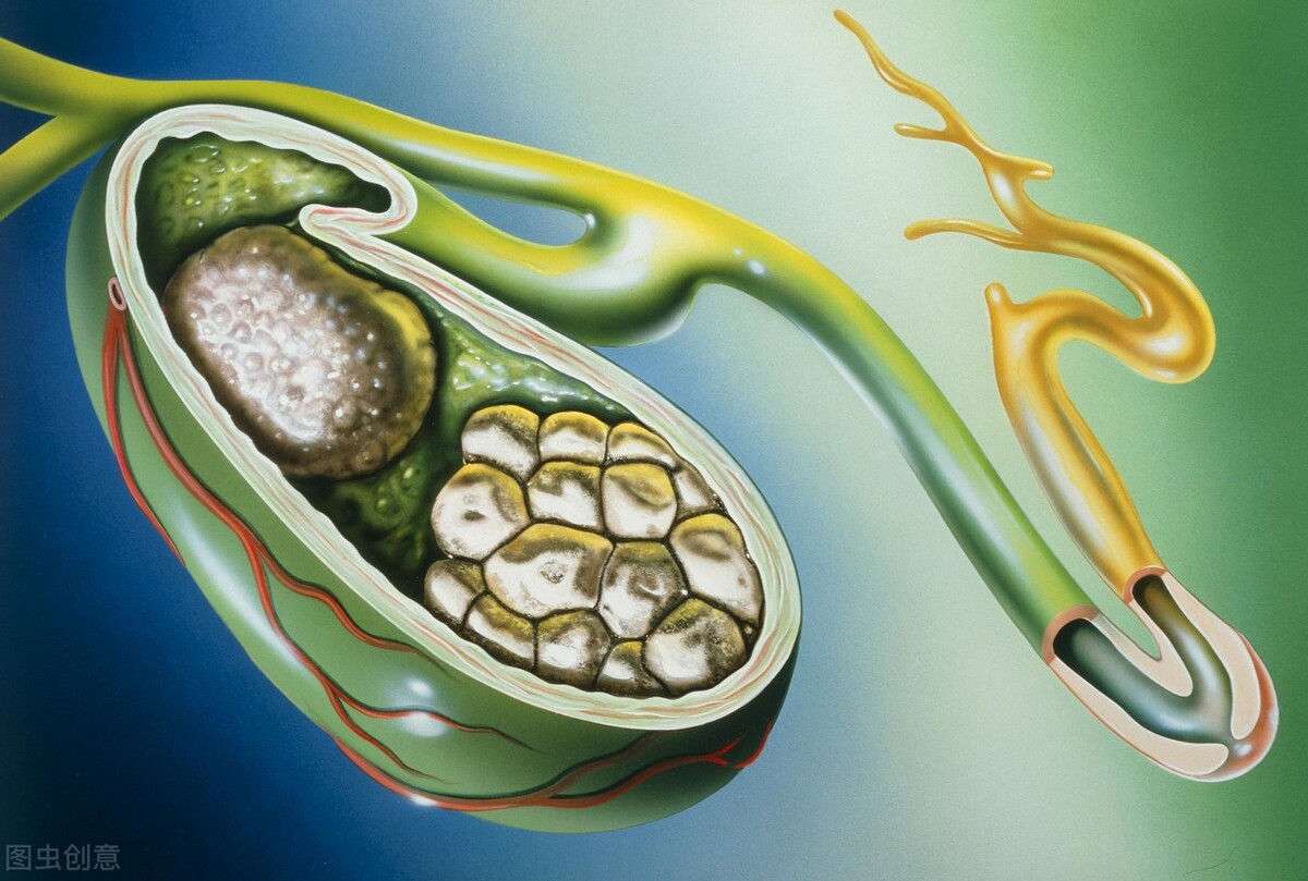 三金排石汤老中医治胆结石方子,治胆结石老中医方剂