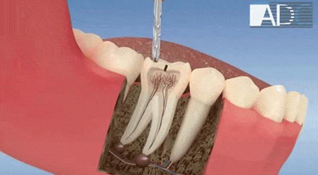 牙齿松了要怎么解决,牙齿松了有什么办法补救