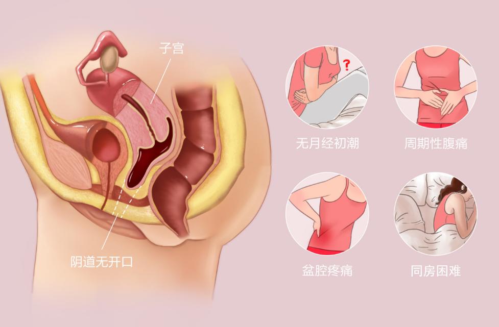 没有阴道的“石女”是怎么回事?还能过夫妻生活吗?答案让人意外