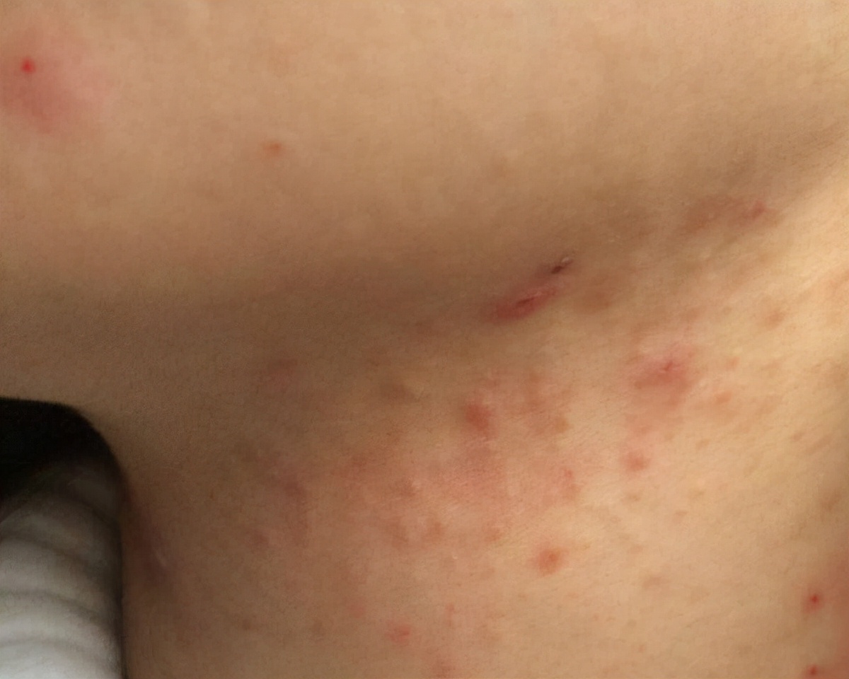 脖子上长痘痘怎么办才能去除,头皮上长痘痘怎么办