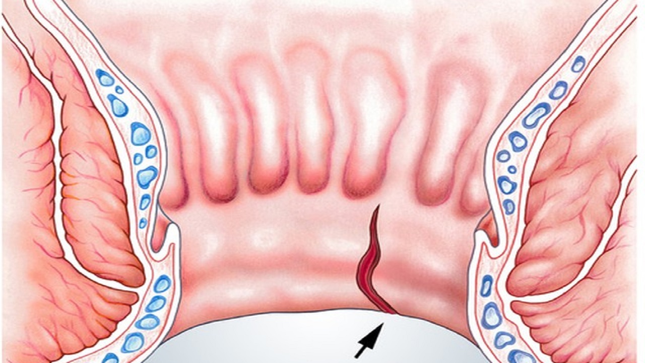女性哪些生活习惯会引发肛裂,18岁女孩肛裂是什么毛病引起的