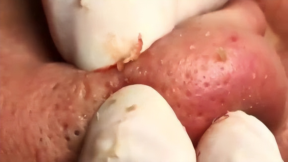 鼻头长黑粉刺怎么回事图片,鼻梁及两侧起了闭口粉刺