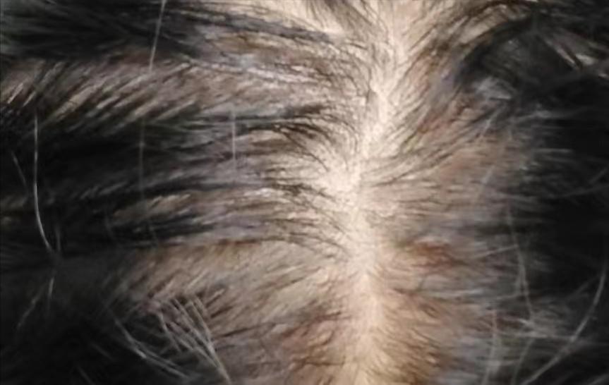 肝血不足导致脱发药方,脱发补气血方子有用吗