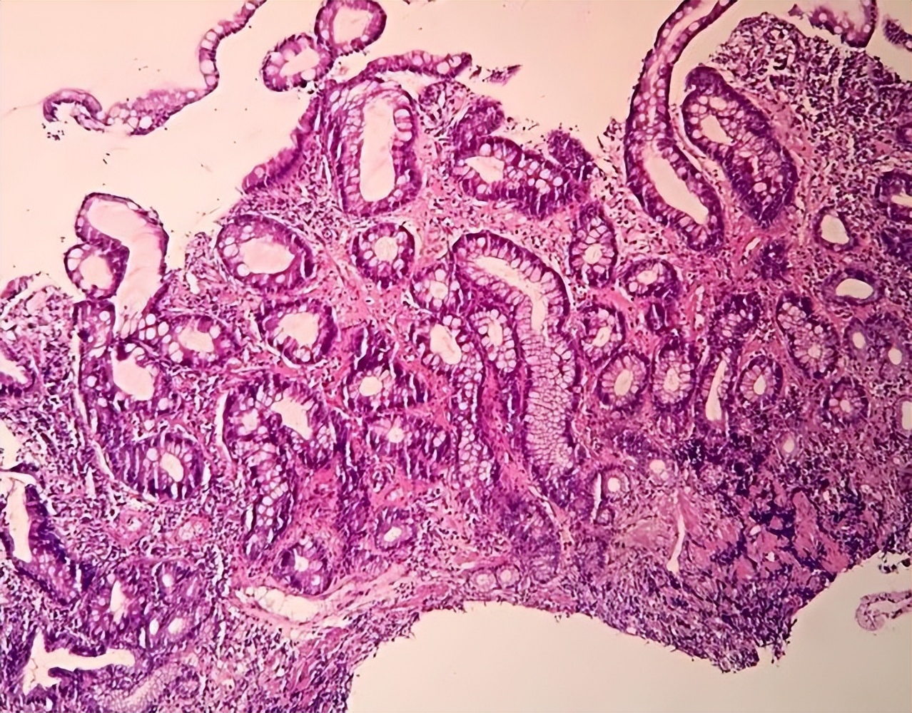 从炎症到癌症三种炎症别拖着,从炎症到癌症一般需要多久