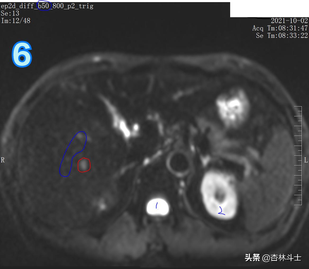 肝癌8公分肿瘤能活多久,肝癌细胞最大长多大