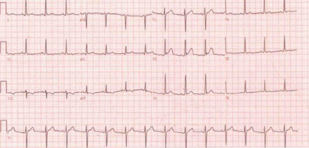 急诊PCI指南,急诊pci治疗费用