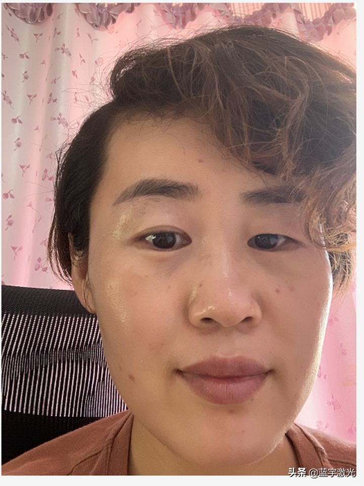 一次激光美白能白到什么程度,激光美白皮肤能维持多久