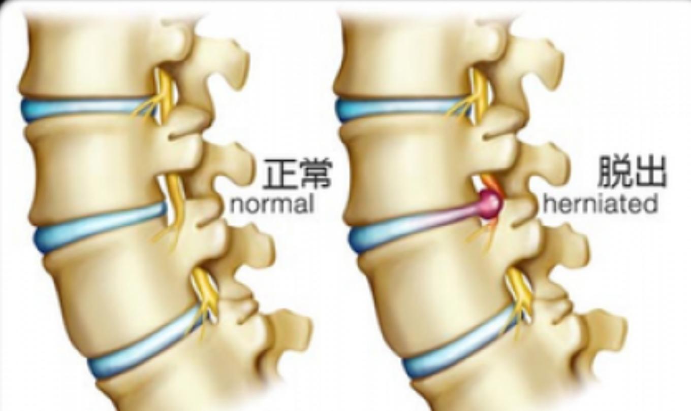 中医针灸治疗颈椎病原理,颈椎病针刀按摩针灸哪种方法好