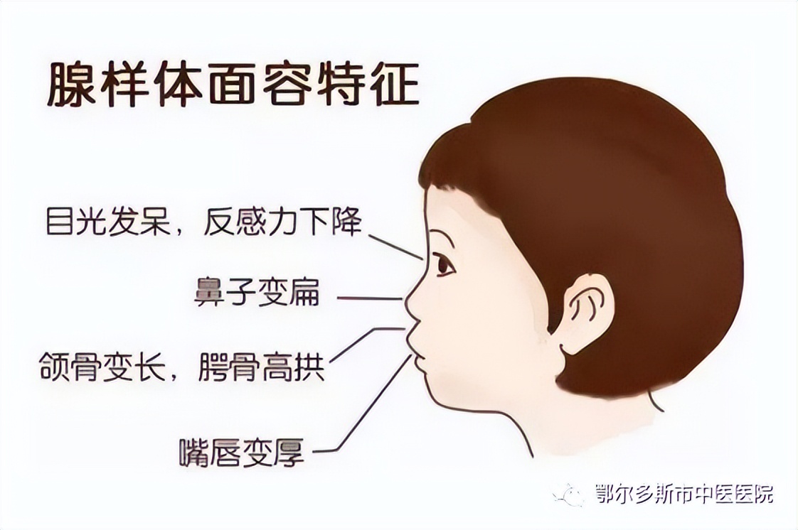 腺样体肥大如何诊断检查呢,腺样体肥大中医诊断是什么
