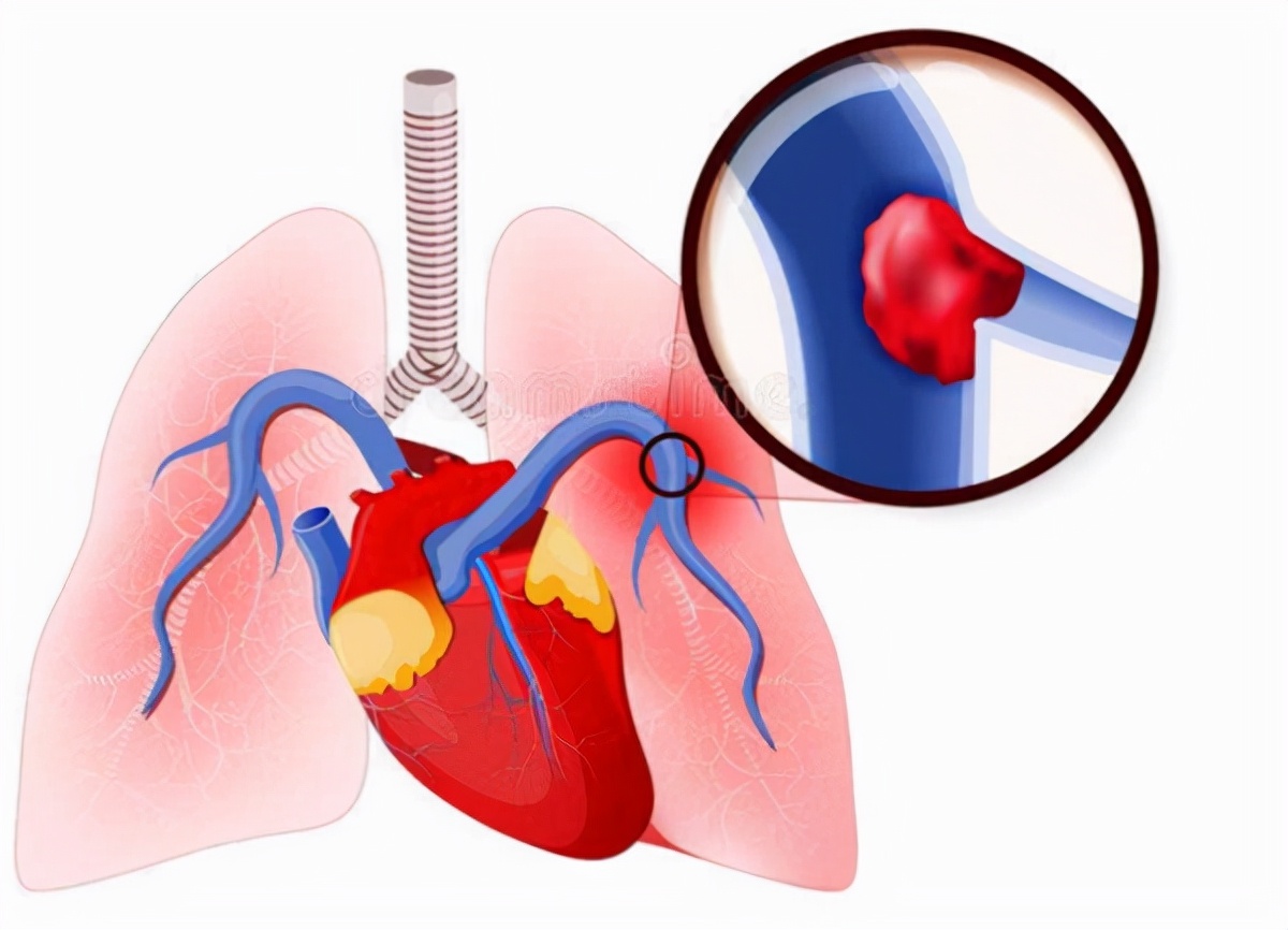 肾病导致肺栓塞多久能恢复,男子肾衰只因一个药