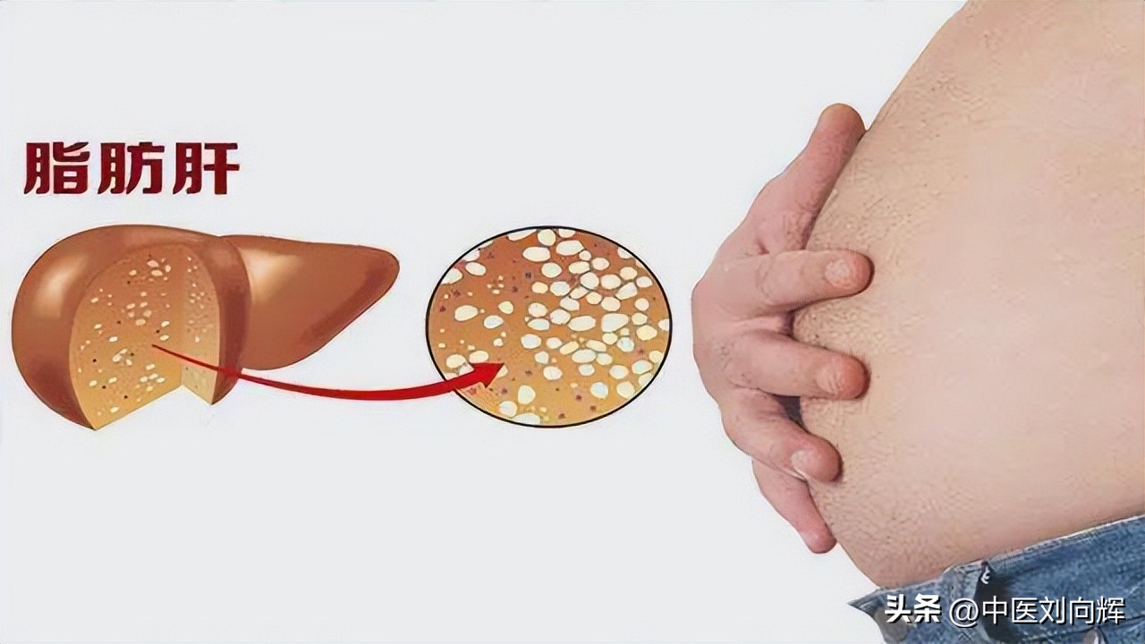 脂肪肝对应中成药,脂肪肝健脾除湿的中成药