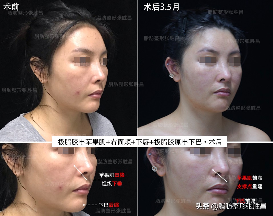 自体脂肪填充丰胸缺点,自身脂肪填充脸部有什么缺点