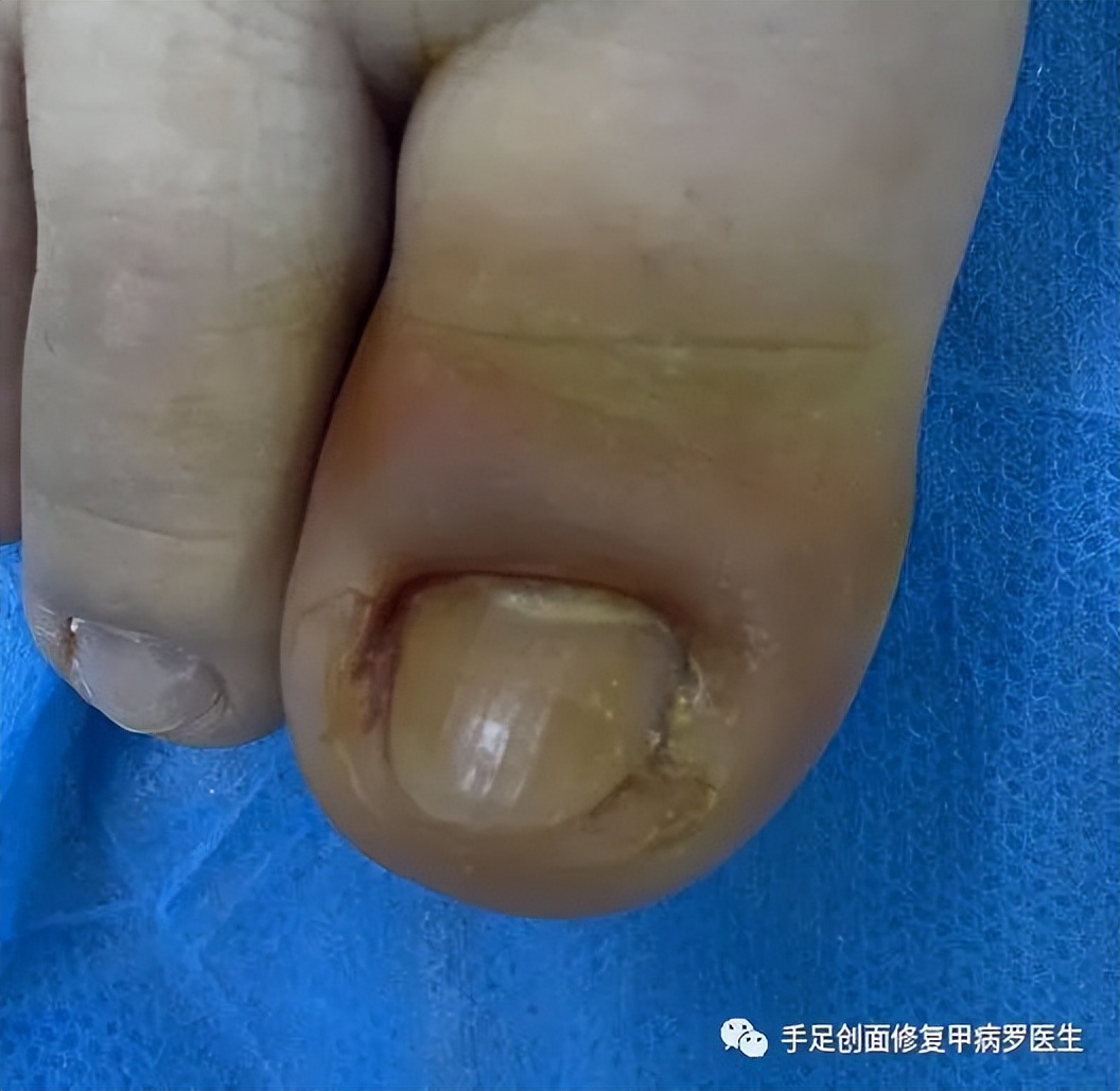 不要等孩子出了问题才重视,孩子得了甲沟炎怎么自己治疗