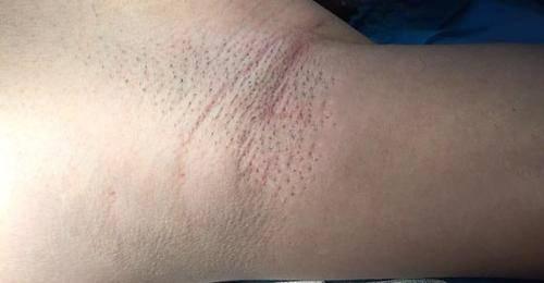 彻底治疗腋臭的方法,最新去除腋臭的手术方法