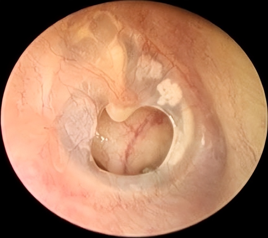 中耳炎耳膜大穿孔手术修补成功率,中耳炎穿孔手术微创