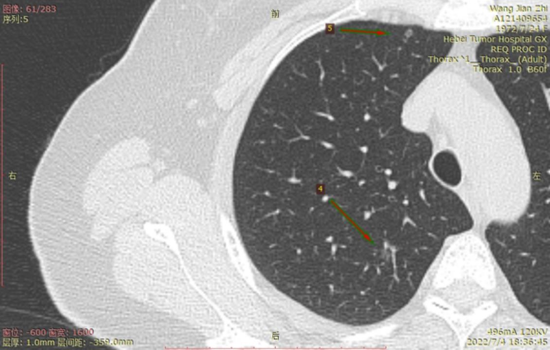 首次发现磨玻璃结节要吃药消炎吗,磨玻璃结节警惕合并占位