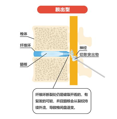 腰椎滑脱康复治疗要多少钱,腰椎滑脱导致脚麻怎么治疗
