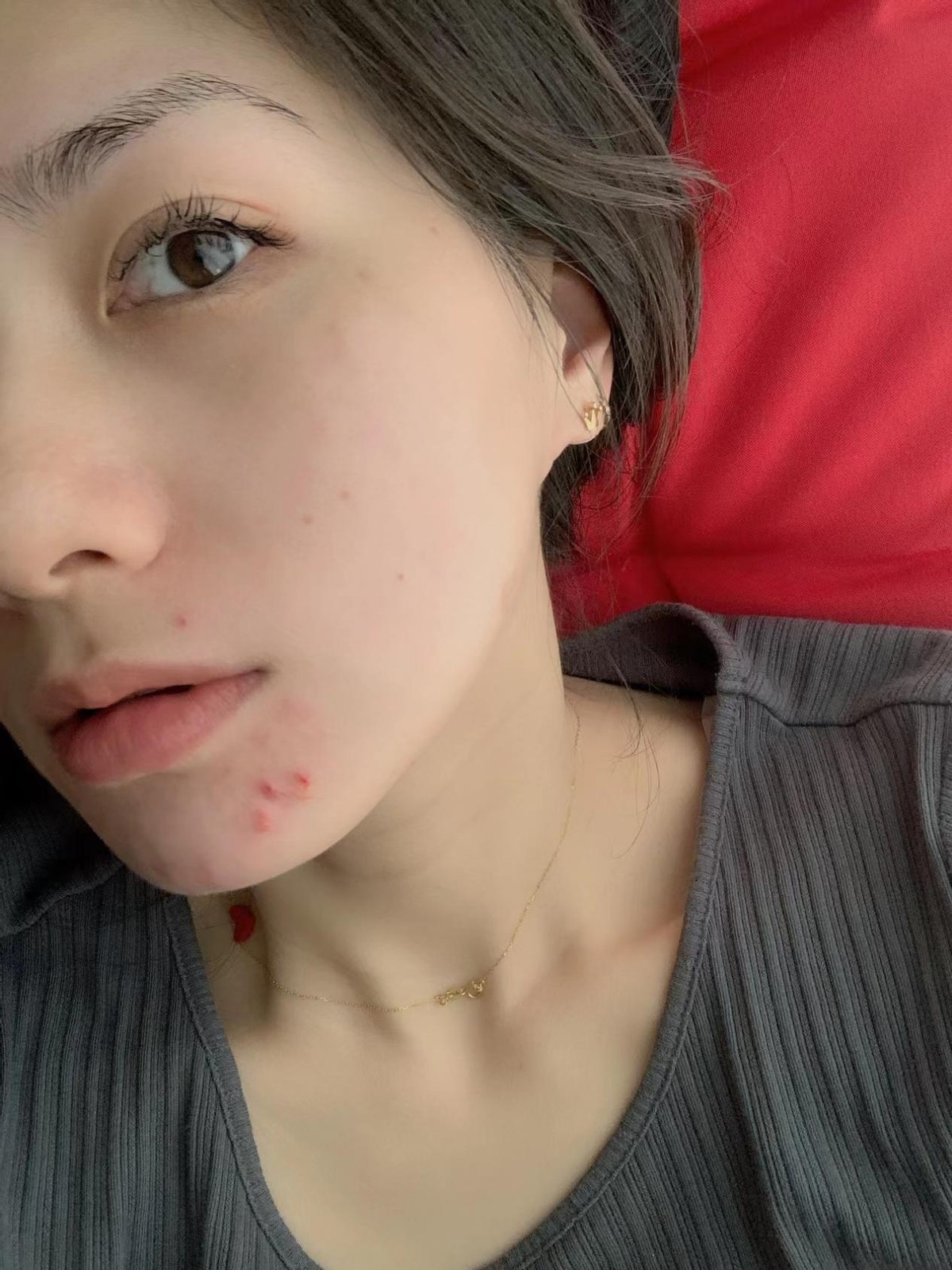 下巴总长痘痘粉刺怎么回事,姨妈之前下巴长痘痘怎么解决