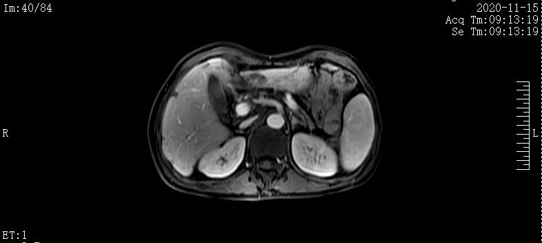 病例实录|免疫联合方案治疗胰腺癌多发转移的病例分享
