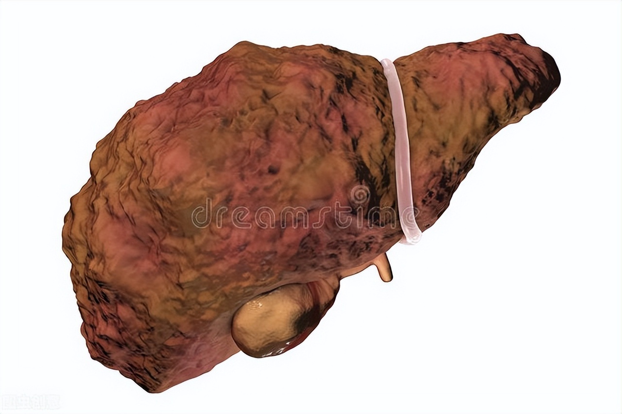 胸前起小红痣是肝硬化吗,肝硬化身上长红痣是怎么回事