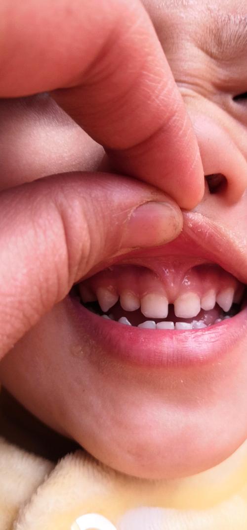 宝宝牙缝有点大正常吗,宝宝牙缝越长越宽是怎么回事