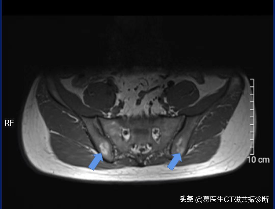 骶髂关节有必要做磁共振吗,患者担心花钱看不好病怎么回答
