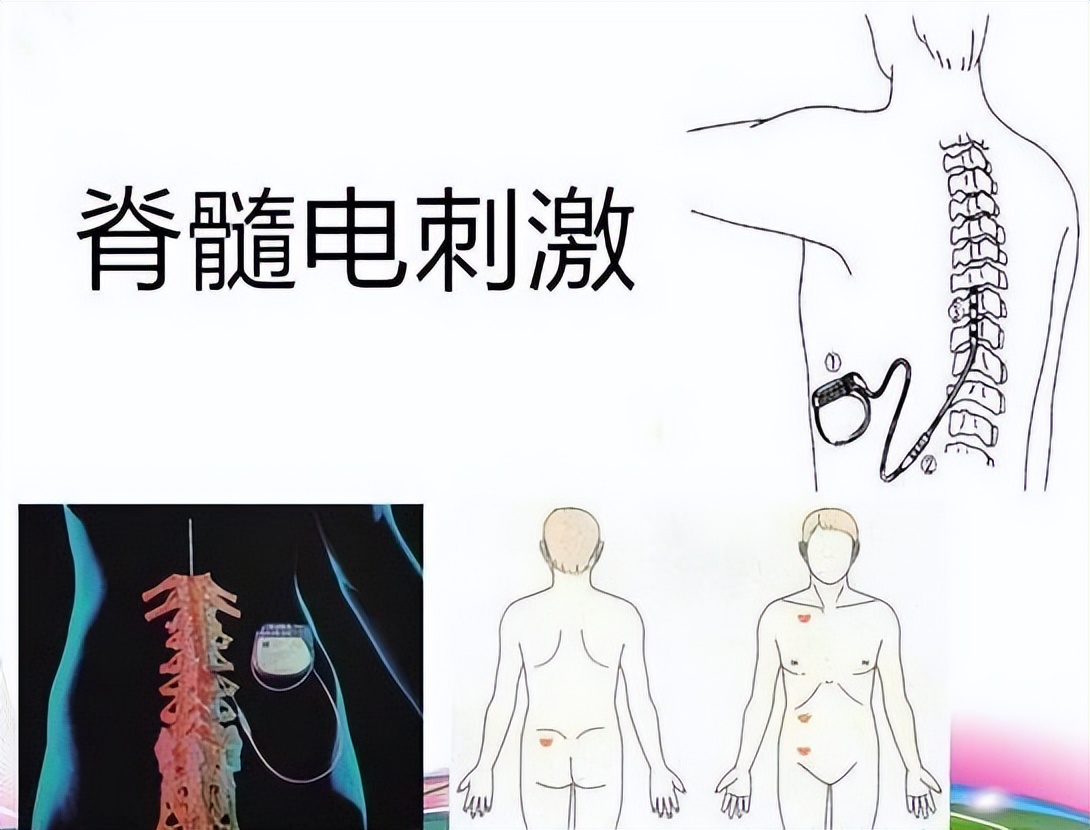 什么是脊髓电刺激疗法?临床上都有哪些应用呢?