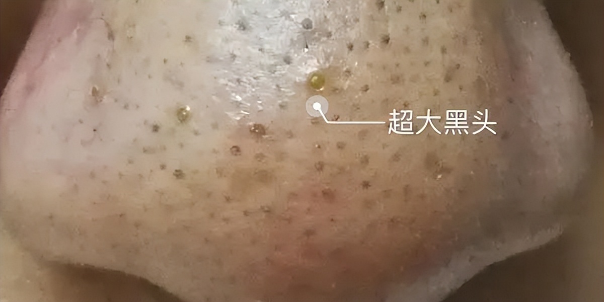 黑头没有弄出来就封口了怎么办,贴黑头贴导致毛孔变大怎么办