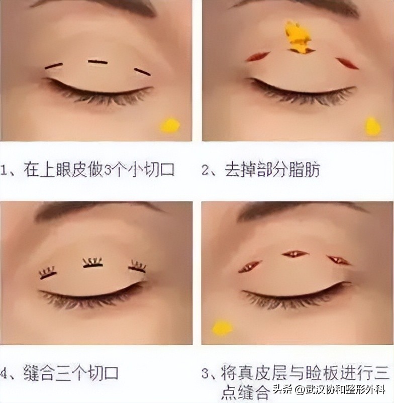 平行双眼皮手术图片,埋线双眼皮手术价格