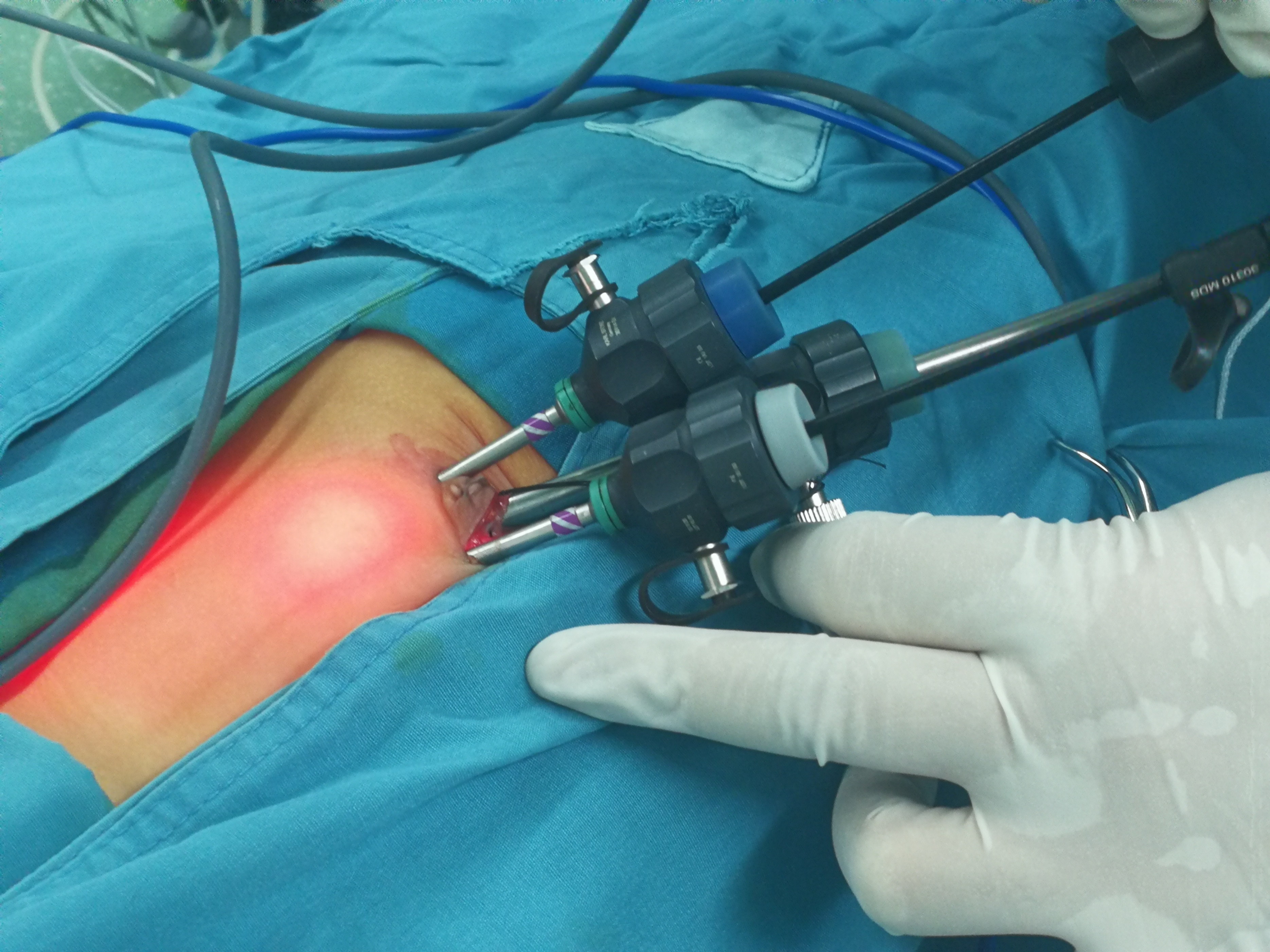 男宝阴囊里面没有“小蛋蛋”，后果可能很严重，家长别大意